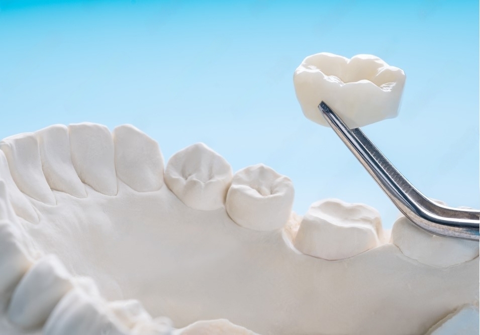 The Power of Porcelain Crowns: Why They’re the Best Choice for Dental Restoration